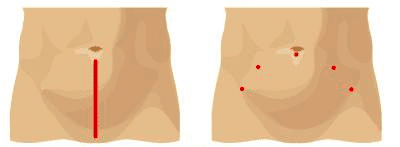 Incisions